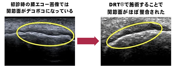 変化の確認が難しいエコー検査でも効果を証明し医学学会での発表を実現!