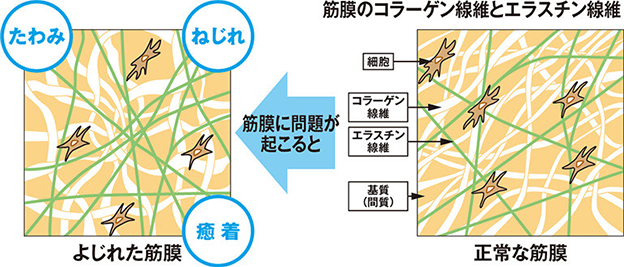 よじれた筋膜の状態だと、たわみ・ねじれ・癒着が発生します