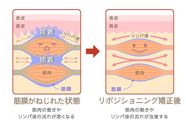 筋膜がねじれた状態からリポジショニング矯正を行うとリンパの流れが改善されます