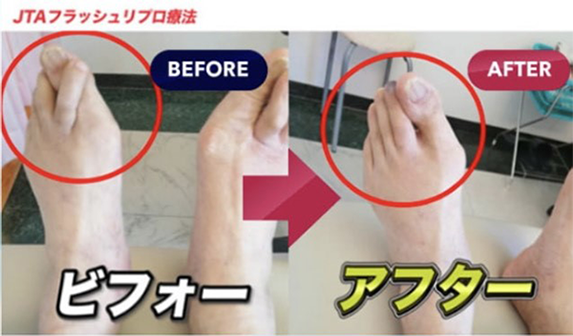 JTAフラッシュリプロ療法のビフォーアフター2